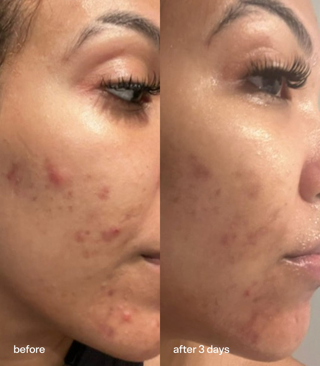 Super Clear Acne Serum by Bubble Skincare