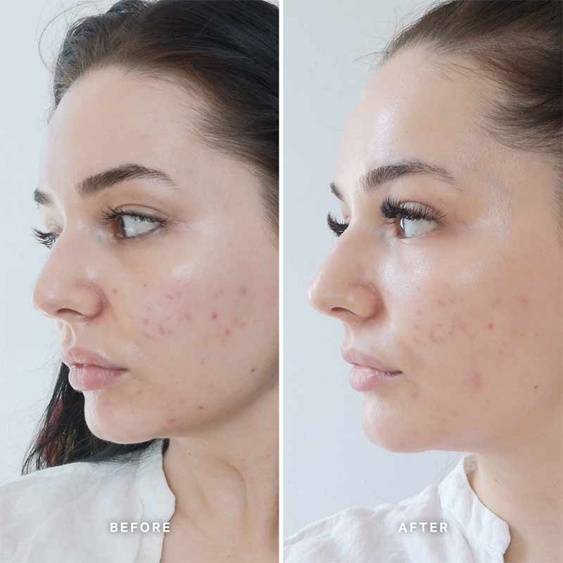 Vitamin B Serum With 5% Niacinamide