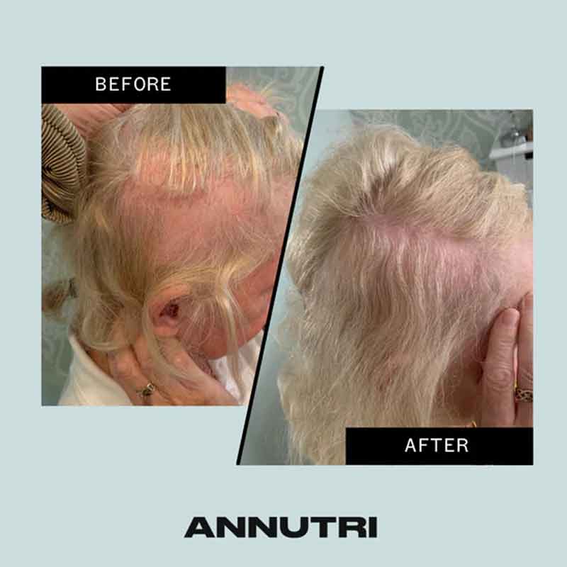 Grow It Hair Growth Supplement 6 Month Supply by Annutri
