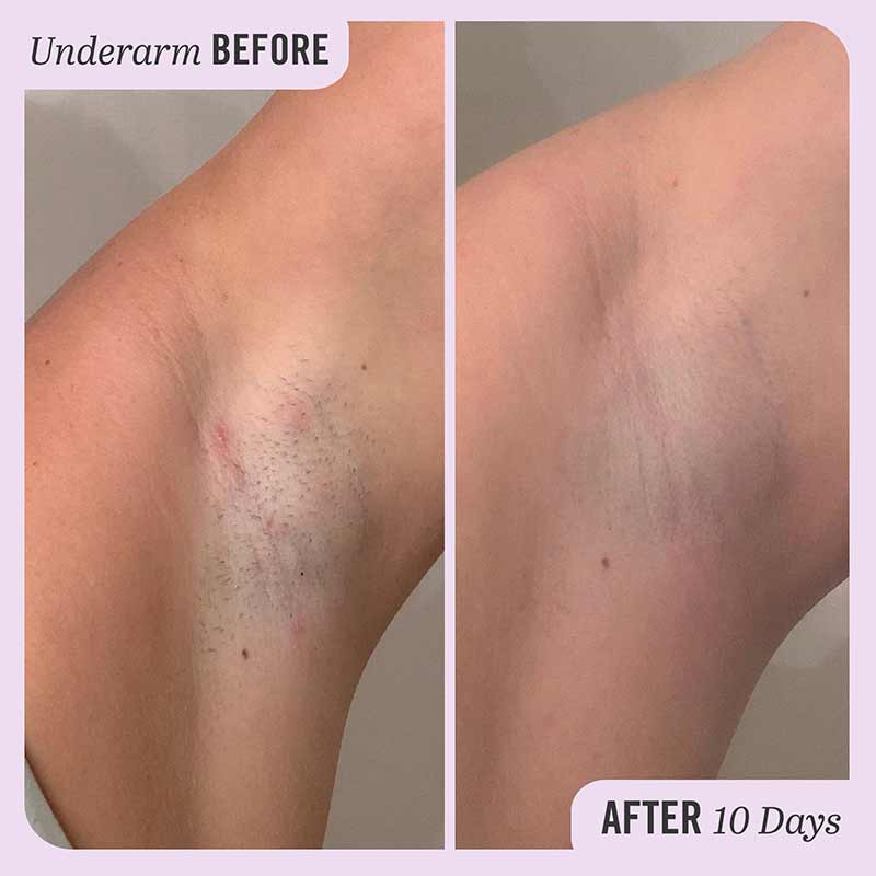 Ingrown Hair Pads 28 Pads