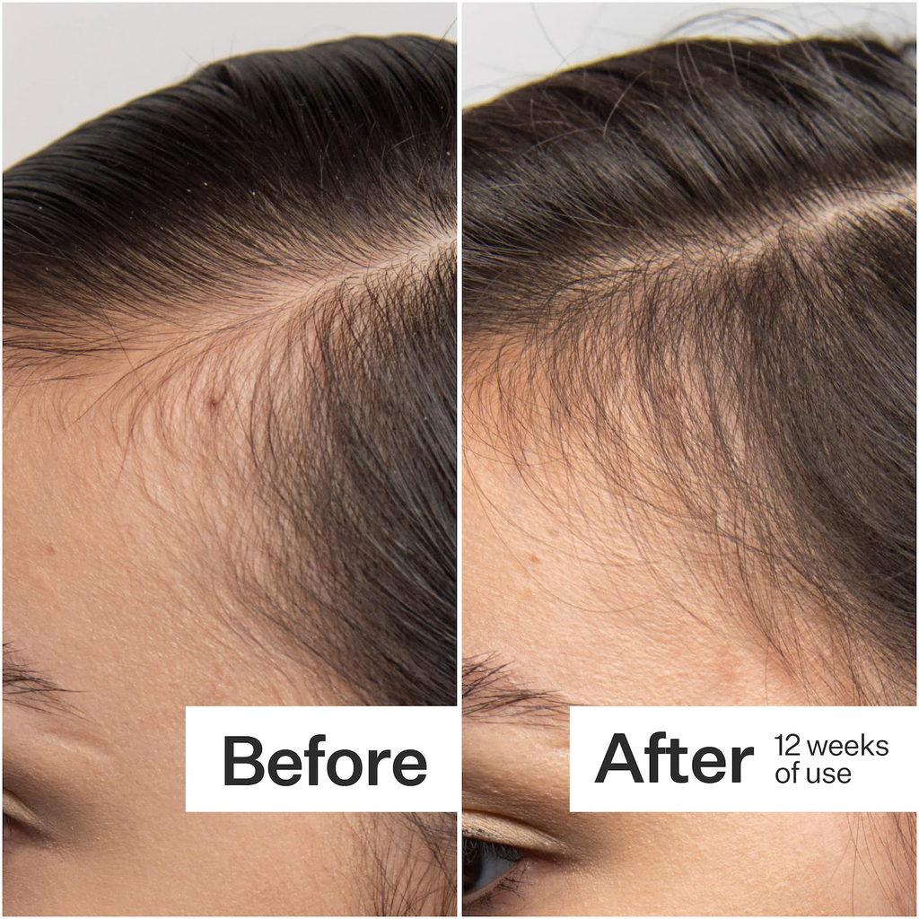 Act+Acre Scalp Dermastamp for Visibly Thicker + Fuller Hair