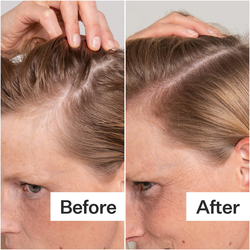 Act+Acre Salicylic Acid Scalp Renew Exfoliator For Oily + Flakey Scalp