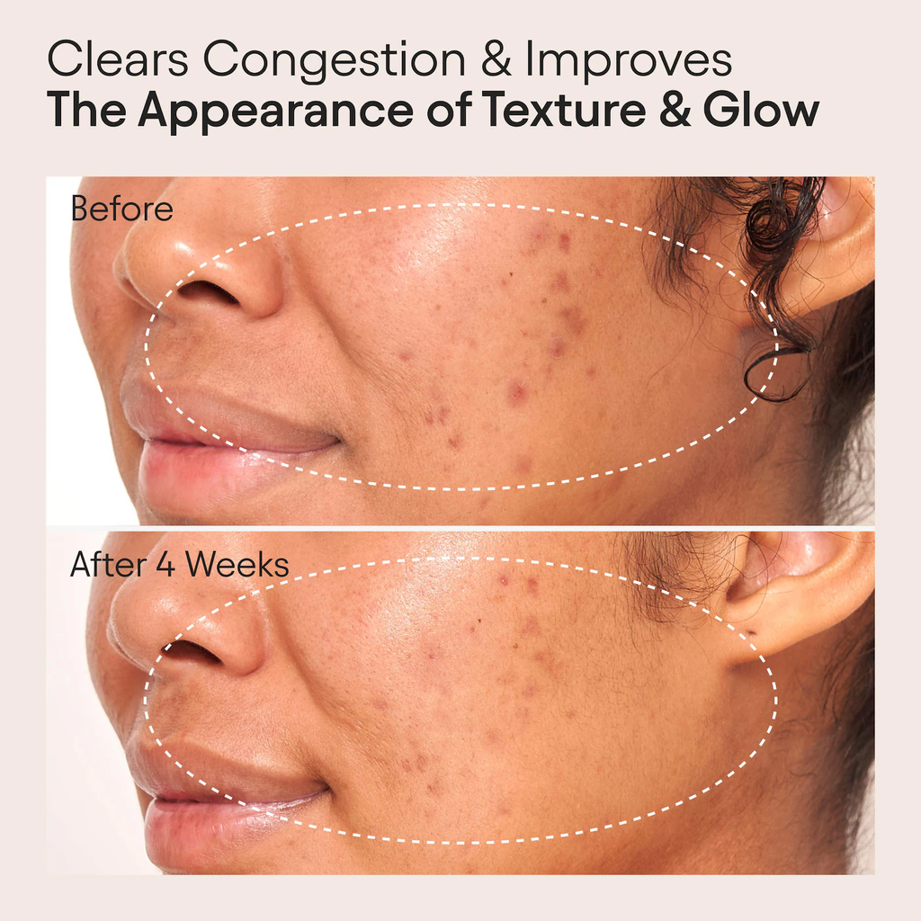ALPYN Retinol Clarifying Oil for Congestion & Wrinkles