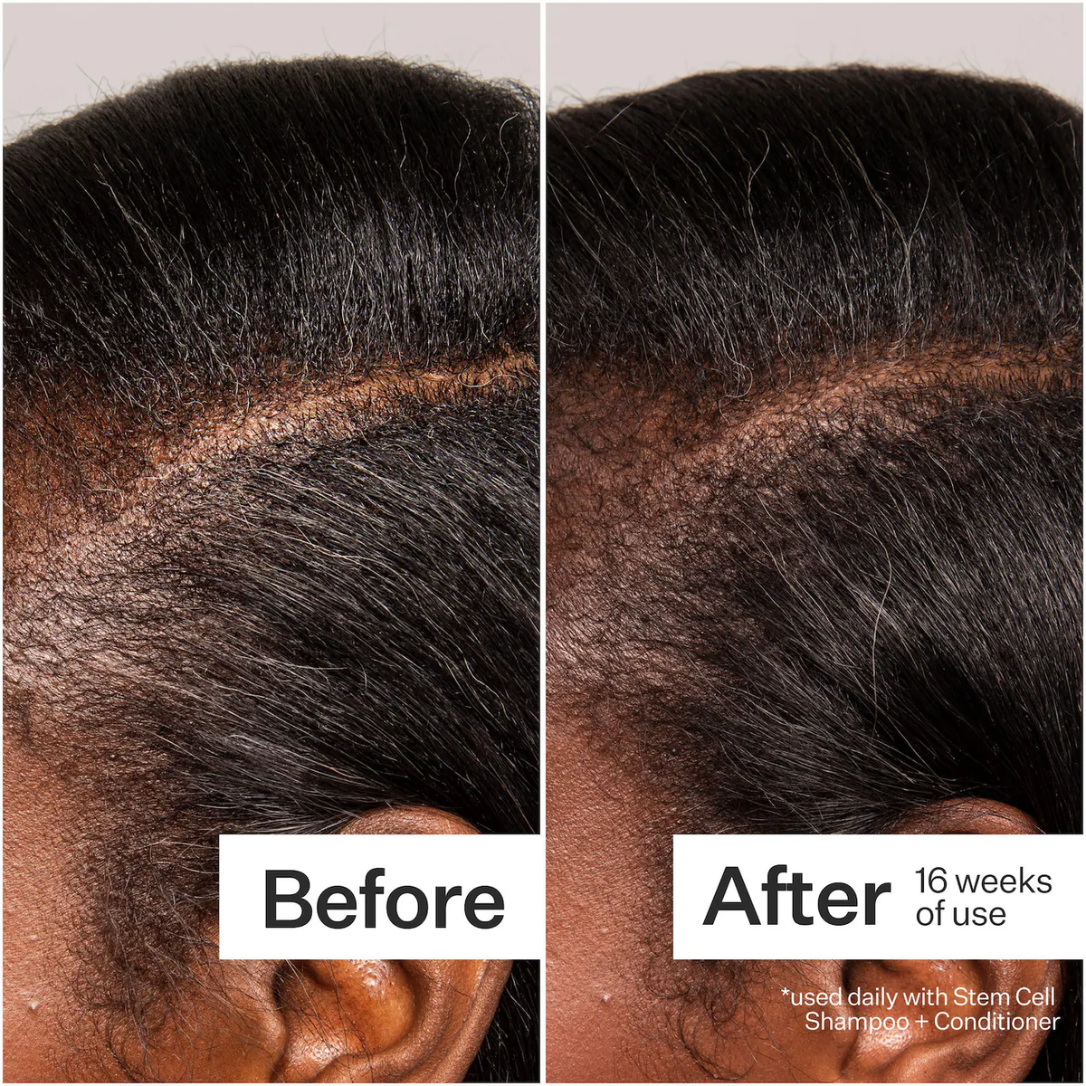 Act+Acre 3% Stem Cell Peptide Hair + Scalp Treatment For Severe Hair Thinning