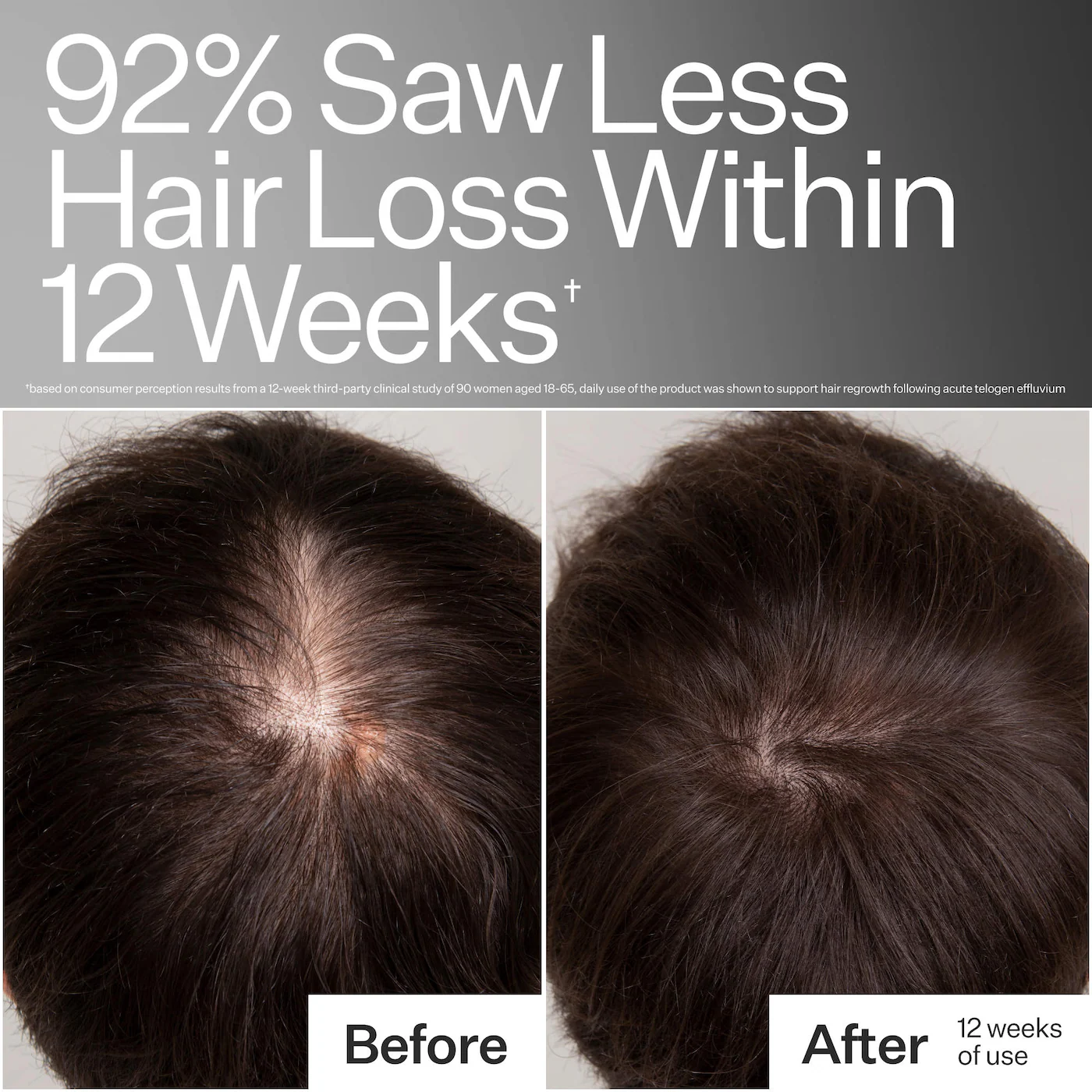 Act+Acre 3% Stem Cell Peptide Hair + Scalp Treatment For Severe Hair Thinning