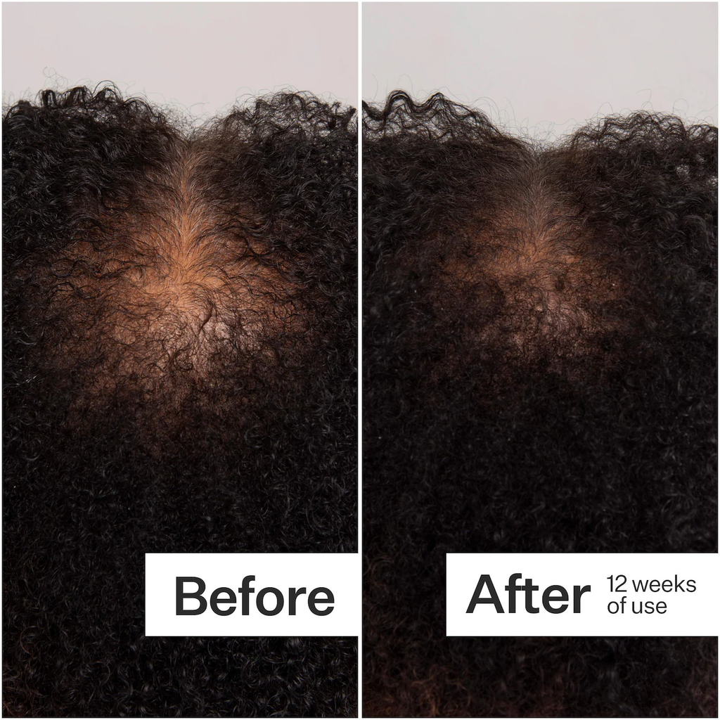 Act+Acre Scalp Dermastamp for Visibly Thicker + Fuller Hair