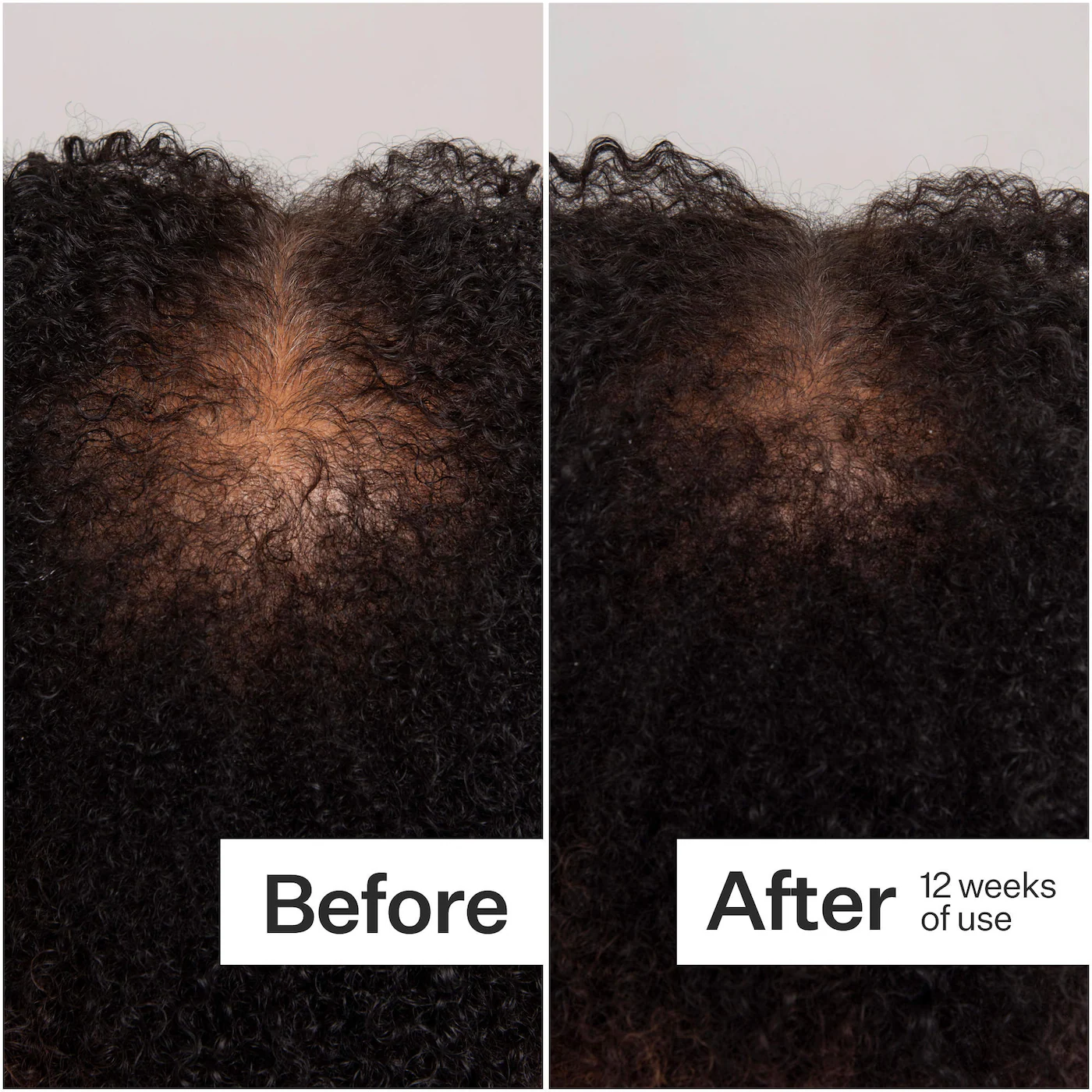 Act+Acre Scalp Dermastamp for Visibly Thicker + Fuller Hair