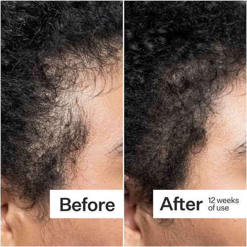 Act+Acre Scalp Dermastamp for Visibly Thicker + Fuller Hair
