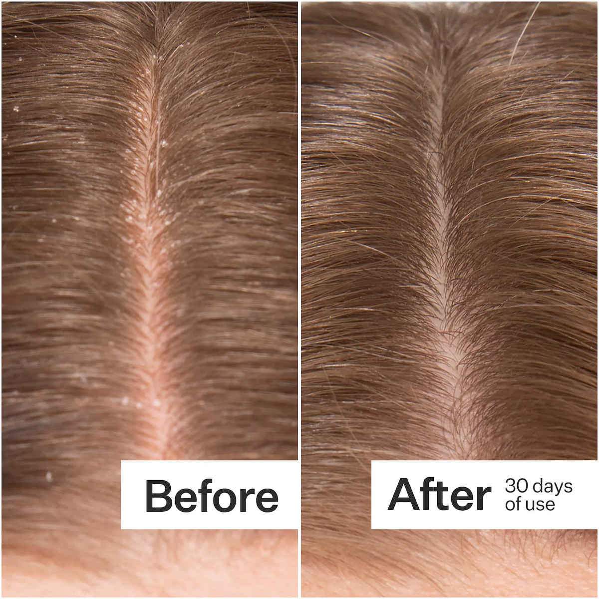 Act+Acre Microbiome Cooling Scalp Serum For Dry Itchy Scalp + Loose Flakes
