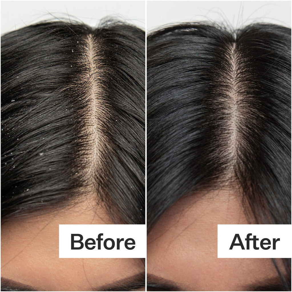 Act+Acre Salicylic Acid Scalp Renew Exfoliator For Oily + Flakey Scalp