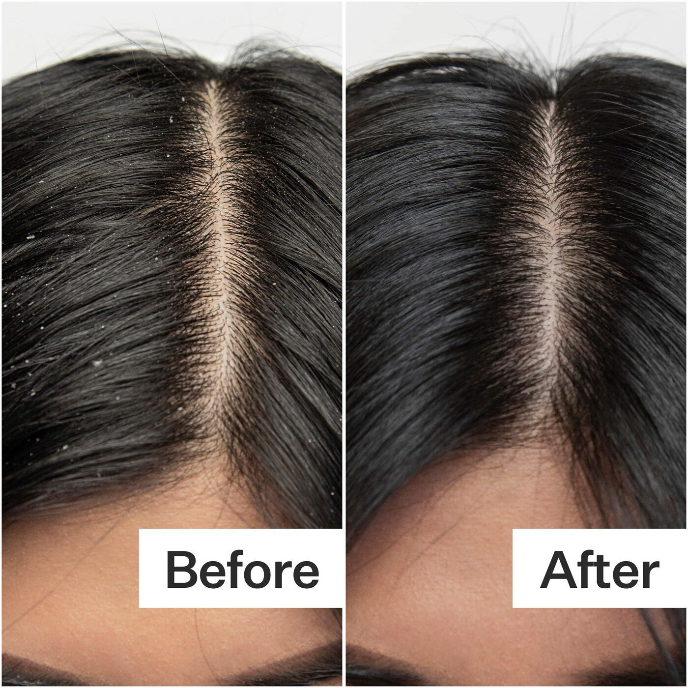 Act+Acre Salicylic Acid Scalp Renew Exfoliator For Oily + Flakey Scalp