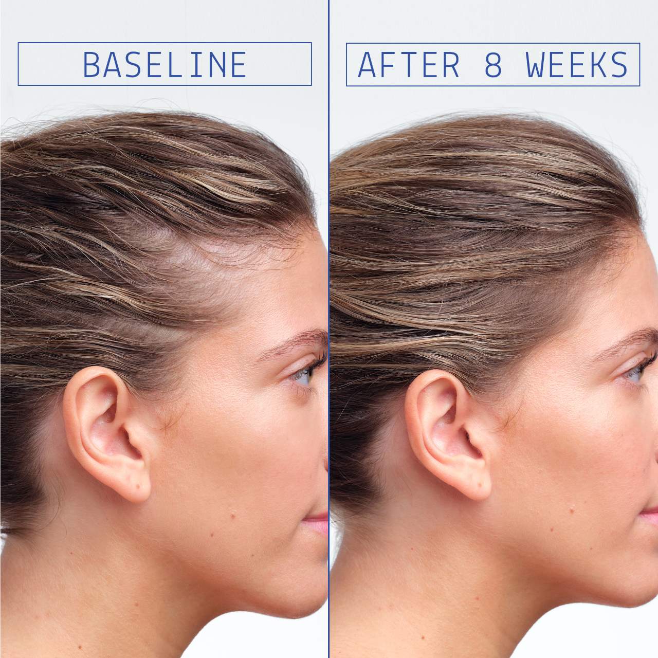 AAVRANI Hair Density Boosting Scalp Serum for Thinning Hair & Hair Loss