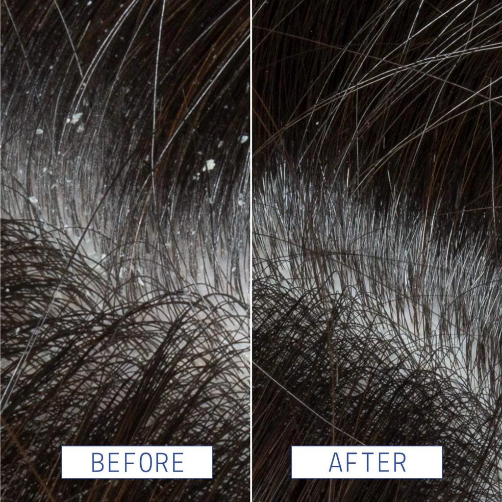 AAVRANI Anti-Dandruff Scalp Serum with Salicylic Acid For Congested + Flaky Scalp