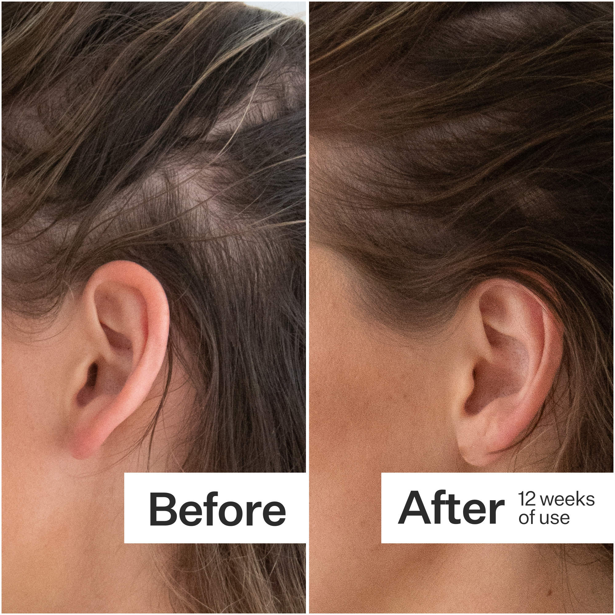Act+Acre Thick + Full Hair Capsules for Fuller-Looking Hair