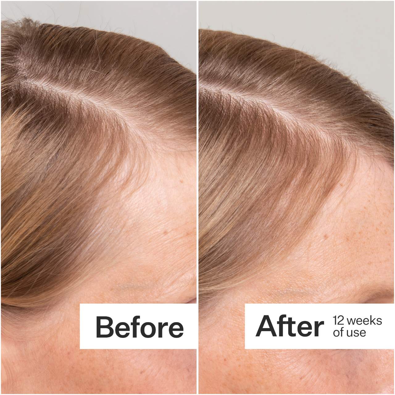 Act+Acre 2% Stem Cell H-2 Grow Complex ™ Scalp Serum For Thicker-Looking Hair