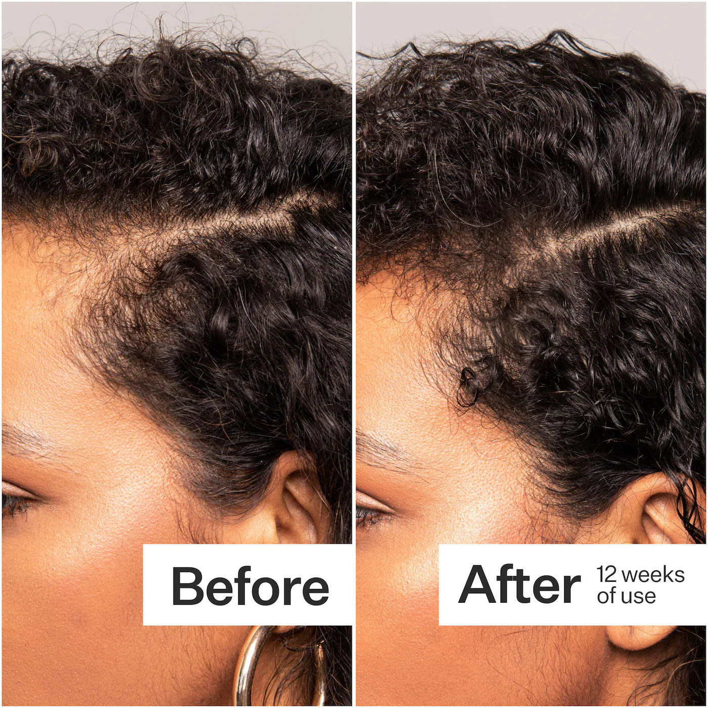 Act+Acre Thick + Full Hair Capsules for Fuller-Looking Hair
