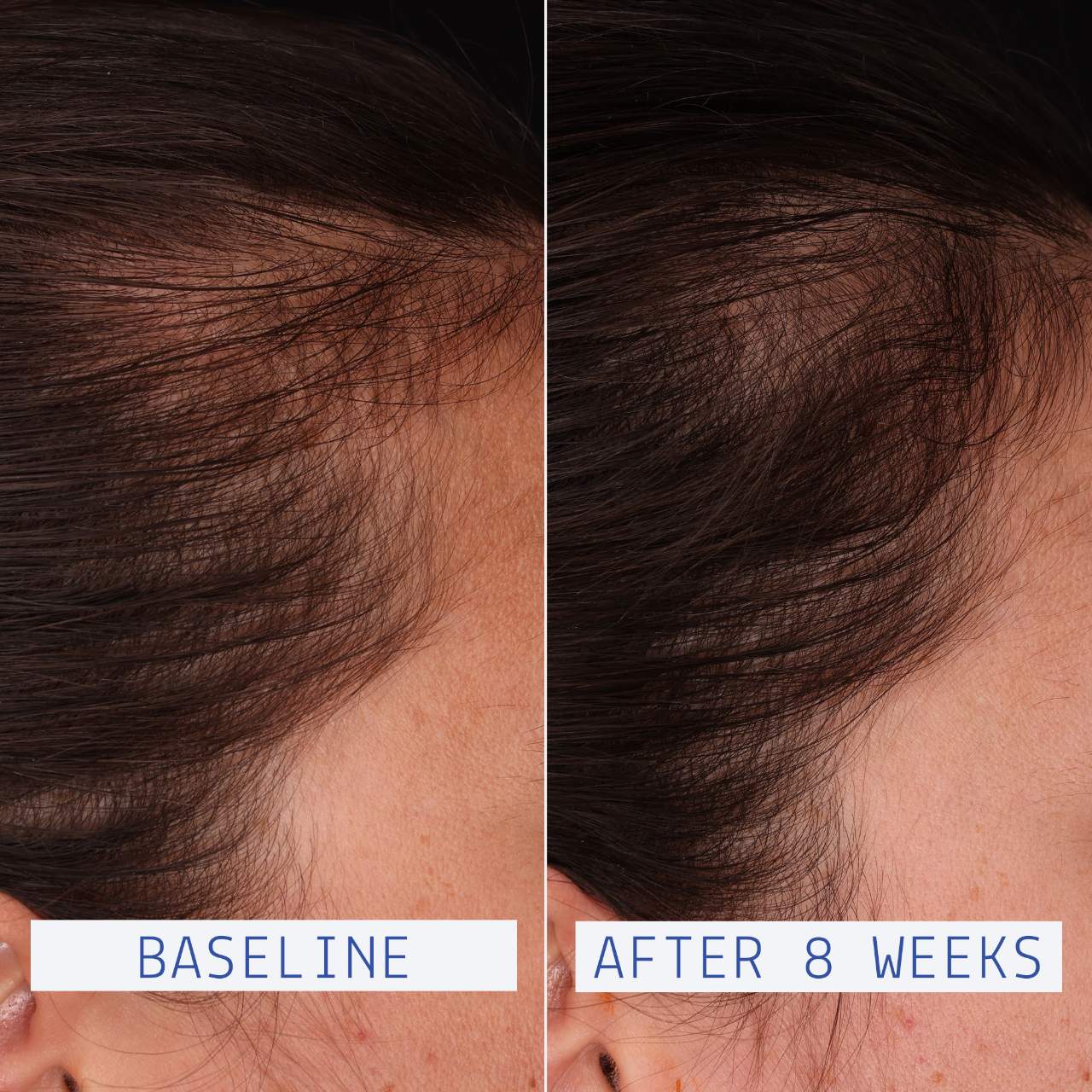 AAVRANI Hair Density Boosting Scalp Serum for Thinning Hair & Hair Loss