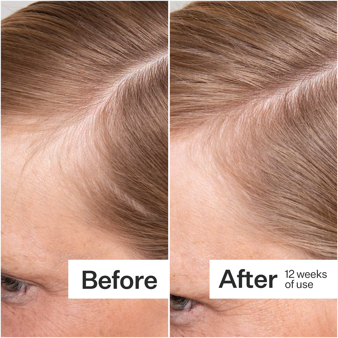 Act+Acre Thick + Full Hair Capsules for Fuller-Looking Hair