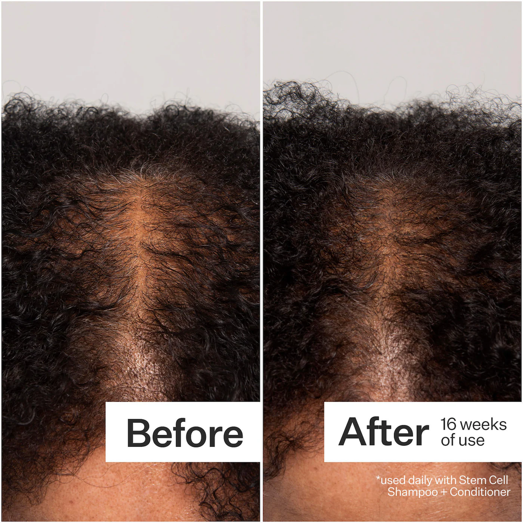 Act+Acre 3% Stem Cell Peptide Hair + Scalp Treatment For Severe Hair Thinning
