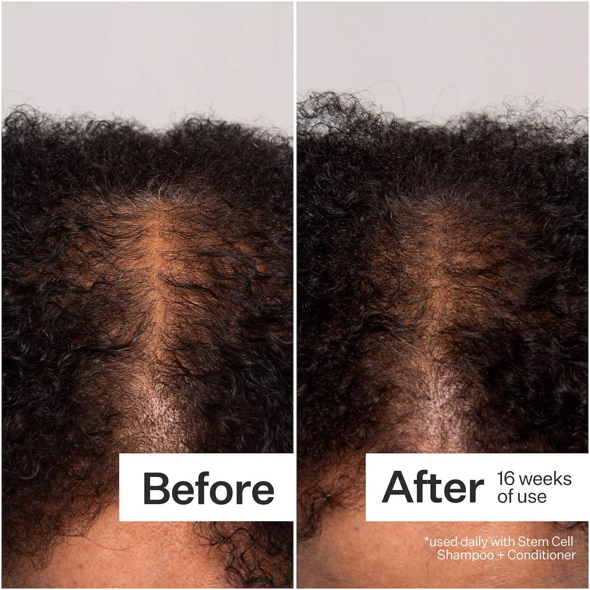 Act+Acre 3% Stem Cell Peptide Hair + Scalp Treatment For Severe Hair Thinning