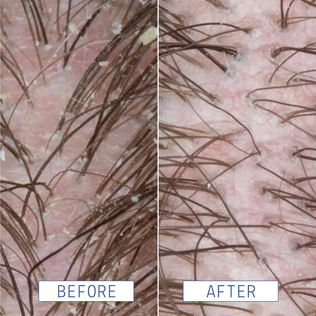 AAVRANI Anti-Dandruff Scalp Serum with Salicylic Acid For Congested + Flaky Scalp
