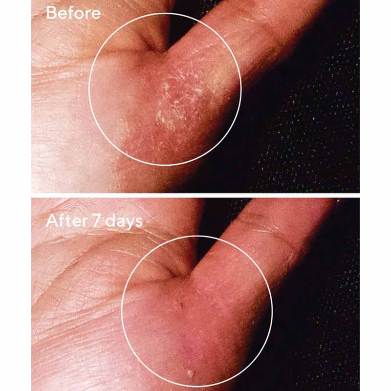 Exasoothe Quick Relief Moisture Treatment