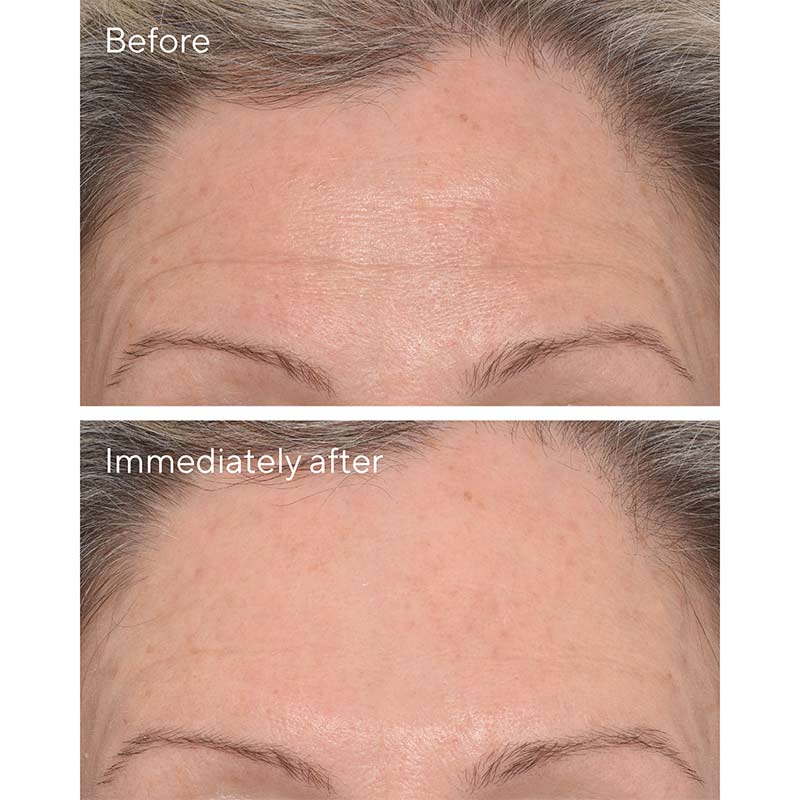Resurgence Targeted Wrinkle Corrector
