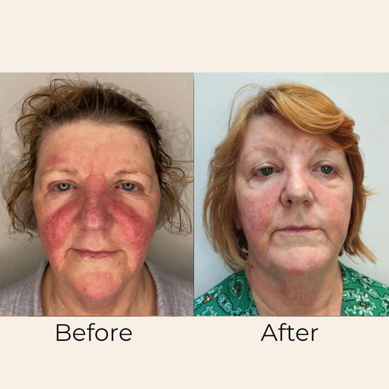 Clear Skin Treatment Serum by Skin Formulas